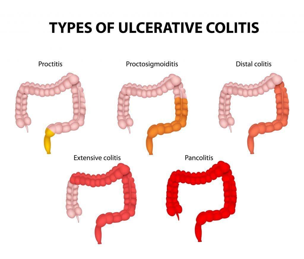 5 drawings of ulcerative colitis
