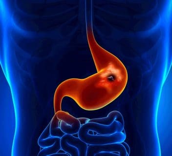 Read more about the article How to Beat the Bacteria That Cause Stomach Ulcers – H Pylori